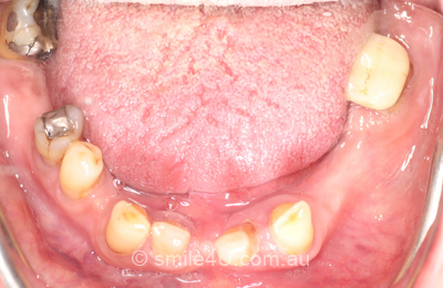 dentures-before2