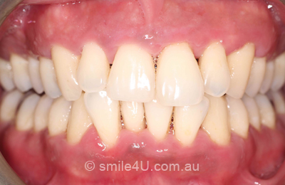 periodontics-after1